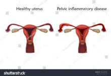 pelvic inflammtory disease(PID) in women's uterus