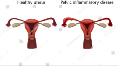 pelvic inflammtory disease(PID) in women's uterus