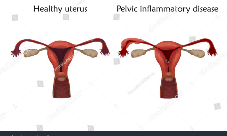 pelvic inflammtory disease(PID) in women's uterus