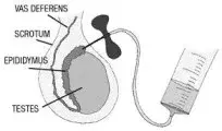 tesa male infertility