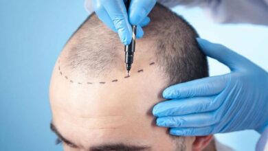 Hair Transplant
