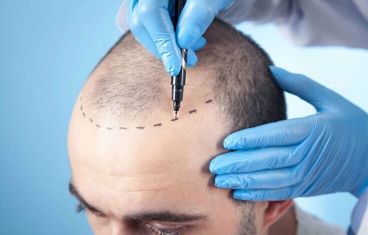 Hair Transplant