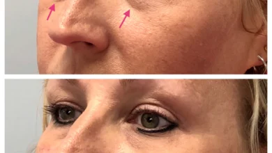 Best treatment for undereyes Chicago