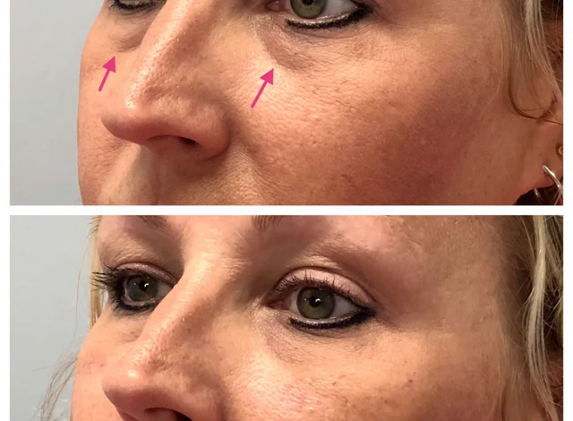 Best treatment for undereyes Chicago