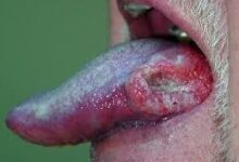 Oral Cancer and Precancerous Lesions in India