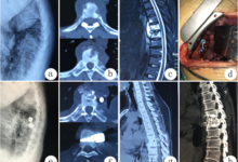 Best Spine Surgery Hospital in Kerala