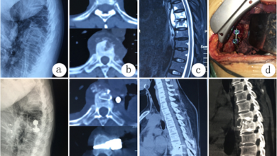 Best Spine Surgery Hospital in Kerala
