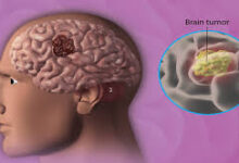 Best Brain Tumor Treatment in India
