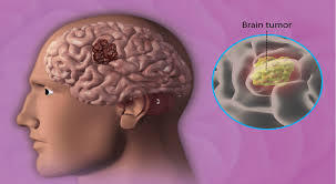 Best Brain Tumor Treatment in India