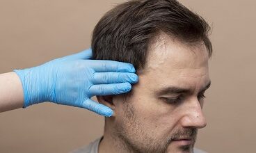 Hair Transplant Doctor in Kolkata