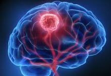 Brain Cancer Treatment in India