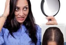 Hair Transplant Treatment in India