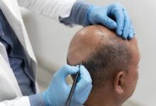 Hair Transplant in Kolkata