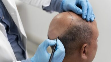 Hair Transplant in Kolkata