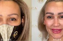 Eyebrow Transplant Chicago