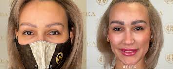 Eyebrow Transplant Chicago