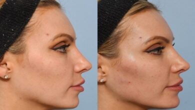 Jawline Contouring West Loop