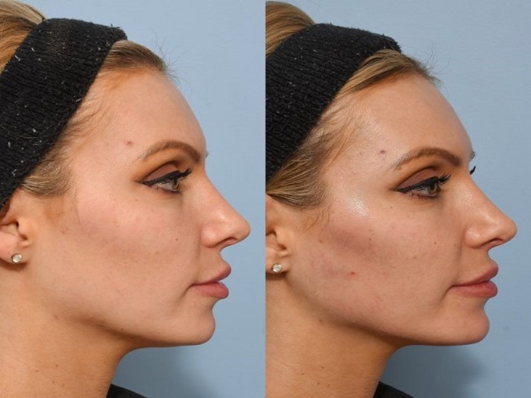 Jawline Contouring West Loop