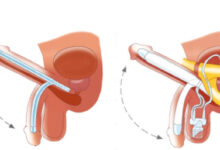 Malleable Penile Implant in India
