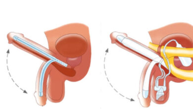 Malleable Penile Implant in India