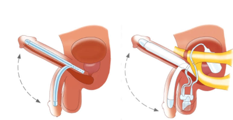 Malleable Penile Implant in India