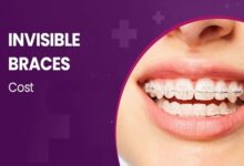 Invisible Braces Cost in Pune