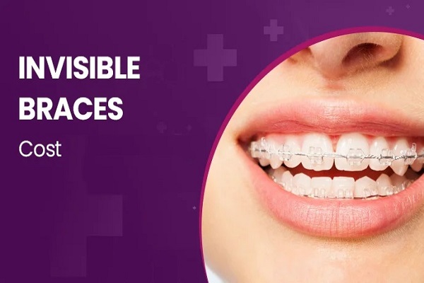 Invisible Braces Cost in Pune