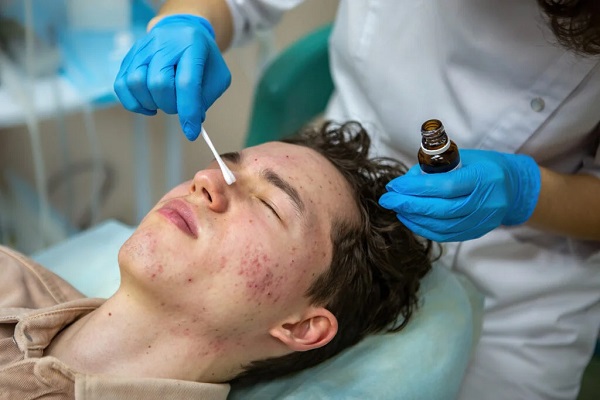 Acne Scar Treatment in Mumbai