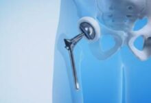 Robotic Hip Replacement in India