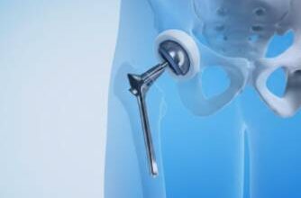 Robotic Hip Replacement in India