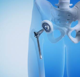 Robotic Hip Replacement in India